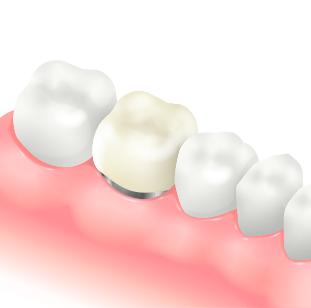 メタルボンドセラミッククラウン